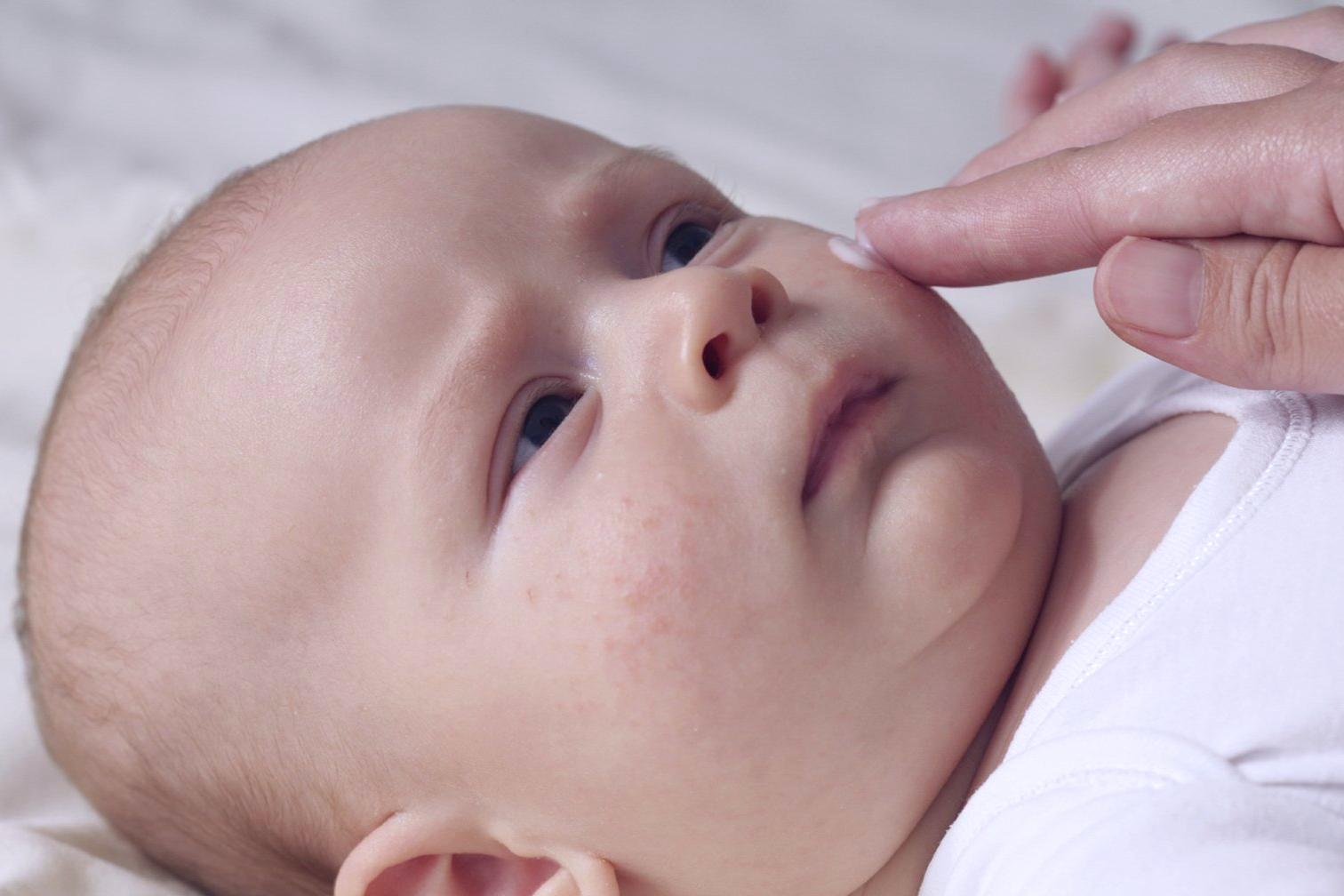 Az ekcéma első jelei a baba bőrén: sokan összekeverik más betegséggel - Gyerek | Femina